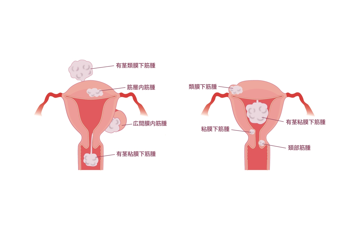 子宮筋腫の図解イラスト